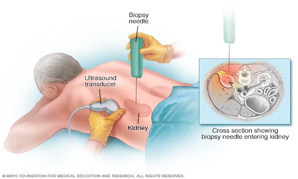 Acute Kidney Disease Treatment