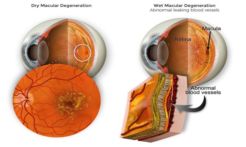 ARMD (Dry Type) Treatment
