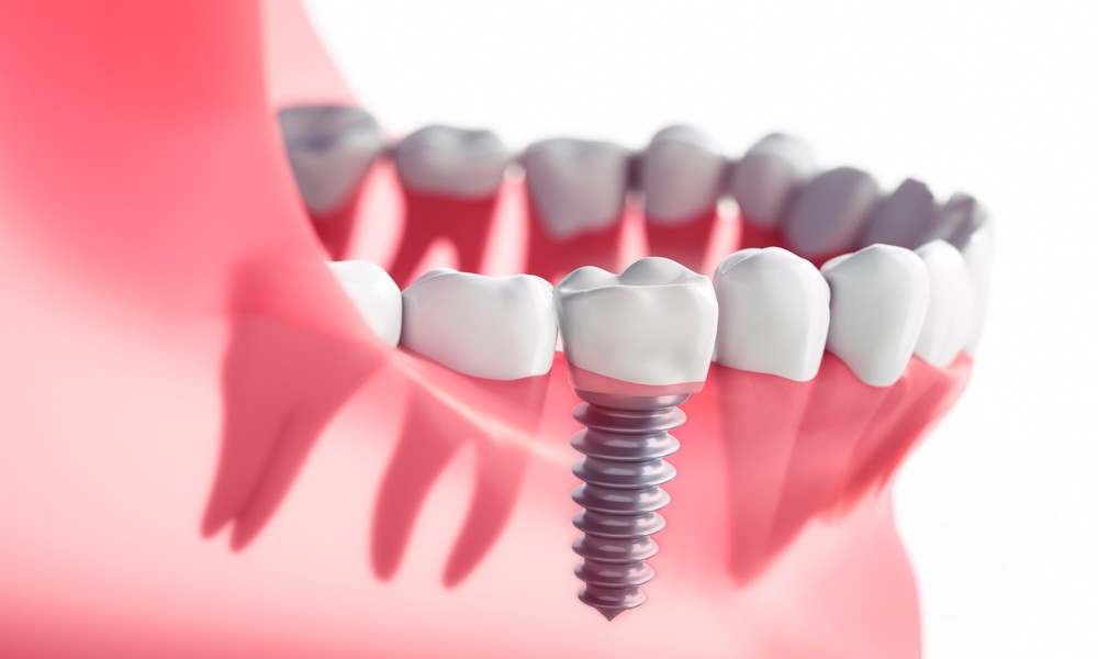 What Questions to Ask Before Getting a Dental Implant in Saratoga Springs